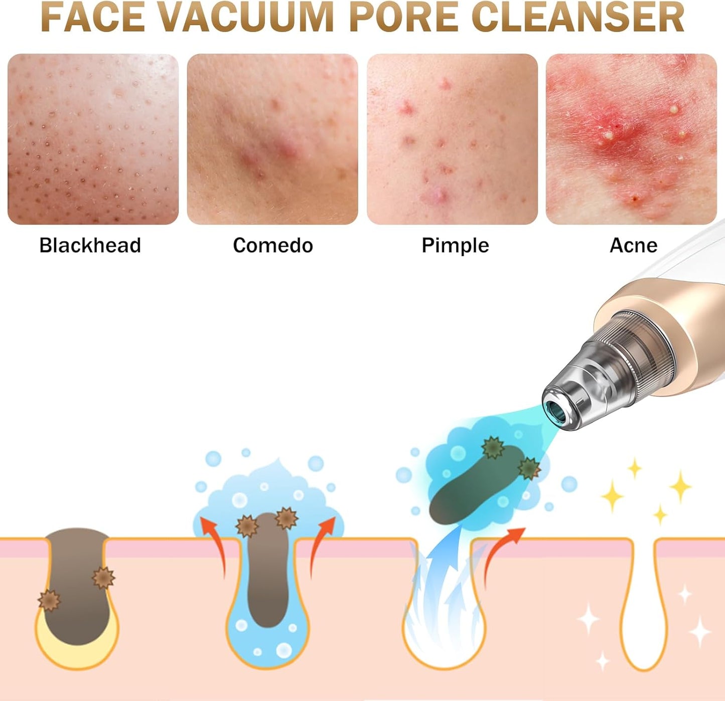 Blackhead Remover Vacuum – 3 Suction Levels, 5 Probes, USB Rechargeable - SmartPagesHub.com