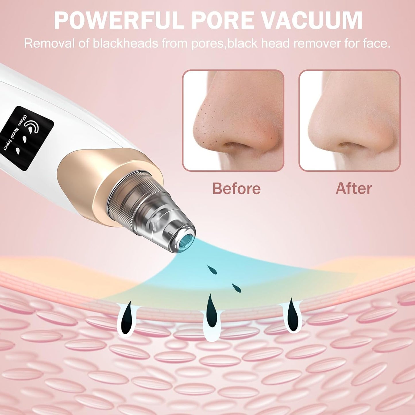 Blackhead Remover Vacuum – 3 Suction Levels, 5 Probes, USB Rechargeable - SmartPagesHub.com